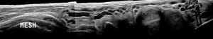 Mesh in inguinal canal along with vericoceles