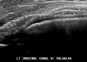Mesh seen in the inguinal canal 