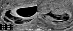subchorionic-hemorrhage-1