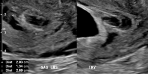 subchorionic-hemorrhage-2