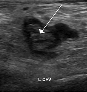 DVT