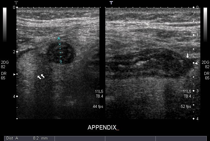 appendicitis