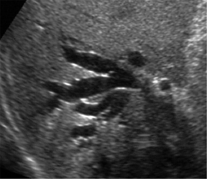 biliary-dilatation