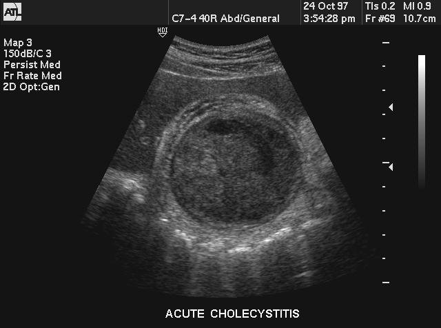 cholecystitis