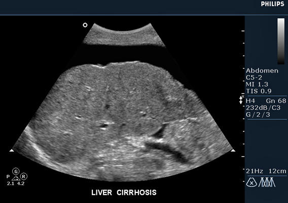 cirrhosis