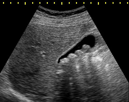 gallstones
