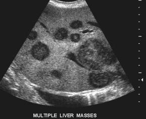 liver-mets