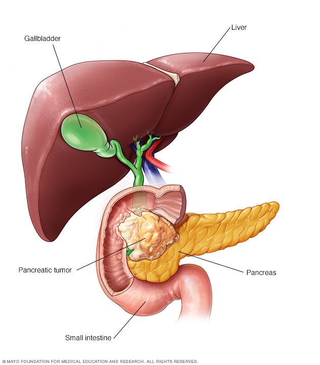 mayo-clinic-pic-of-pancreatic-mass