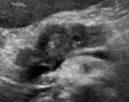 pancreatic-mass-1a
