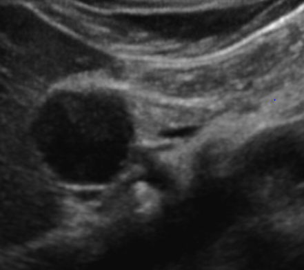 pancreatic-mass-2