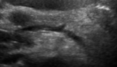 pancreatic-mass-3