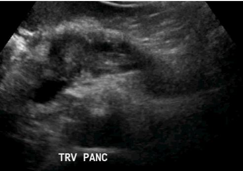 pancreatic-mass