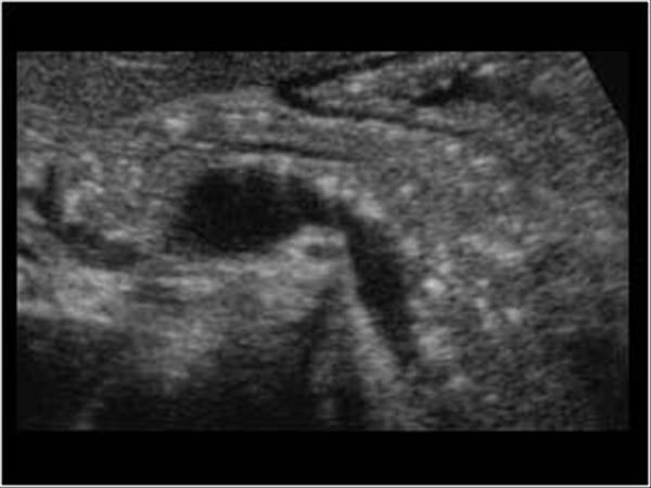 pancreatitis